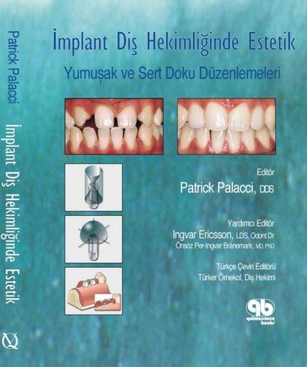 Implant-Dis-Hekimliginde-Estetik