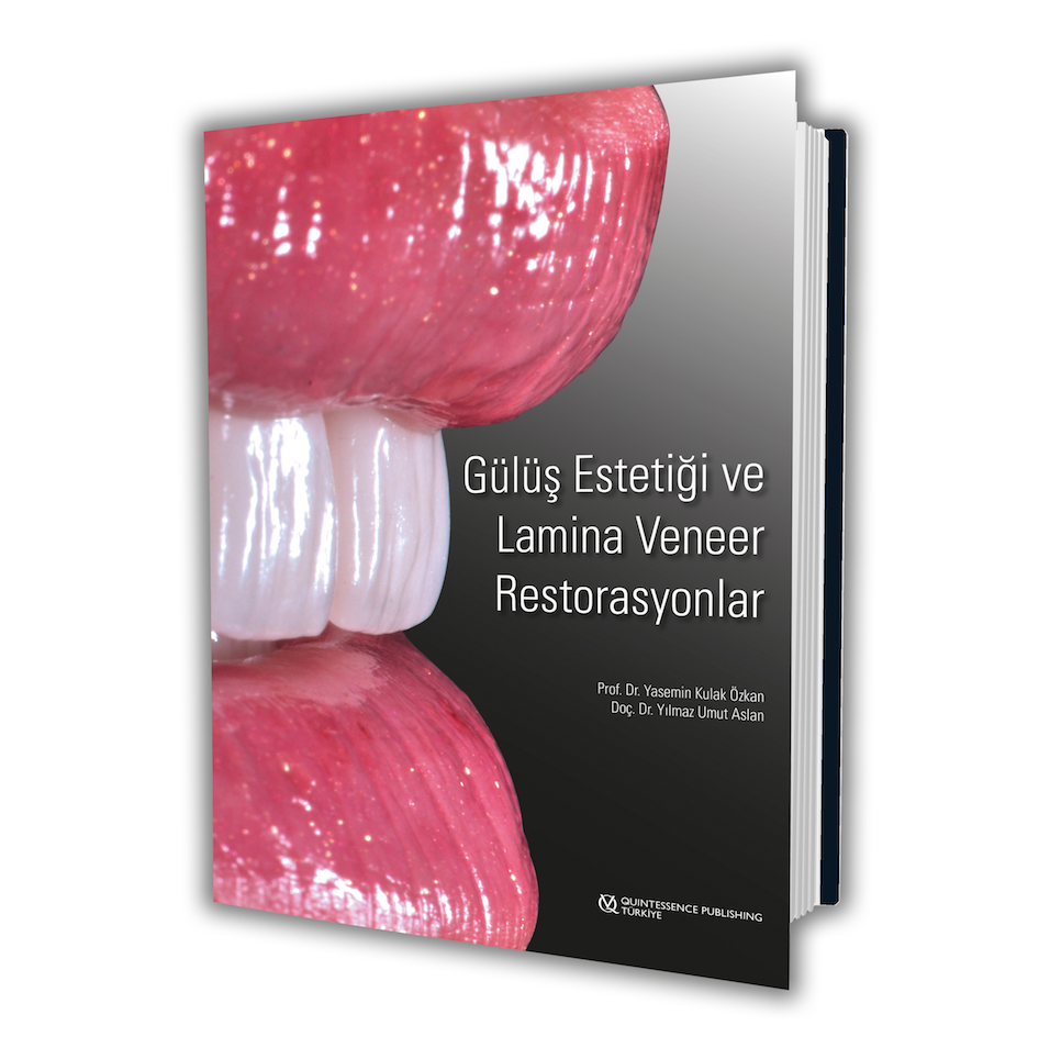 gülüs-estetigi-ve-lamina-veneer-restorasyonlar